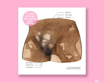 The Vulva • Anatomy • Vitiligo • Educational Art Print • The Vulva Gallery