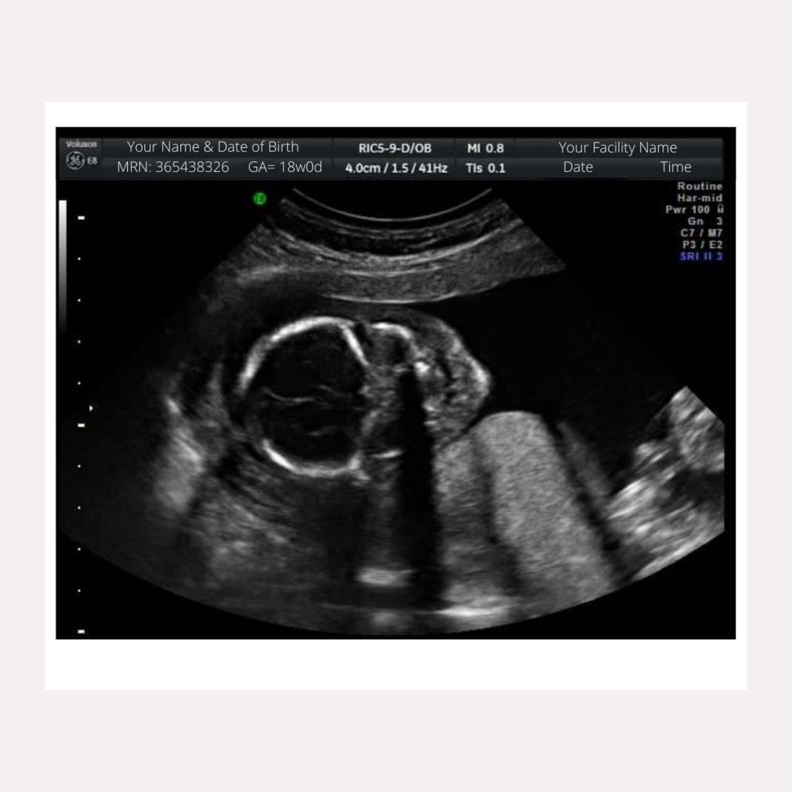 Fake Ultrasound Prank - nby1ng8