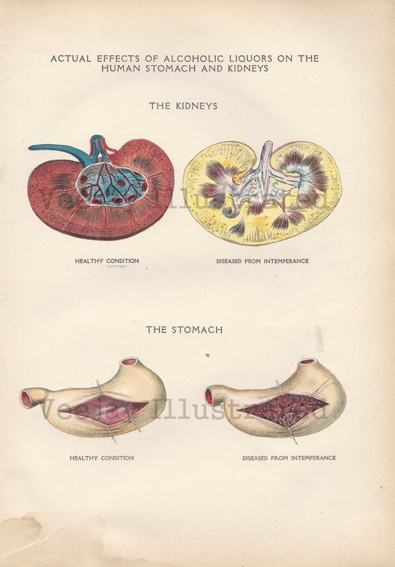 Effects of Alcohol on Stomach and Kidneys Human Anatomy Etsy