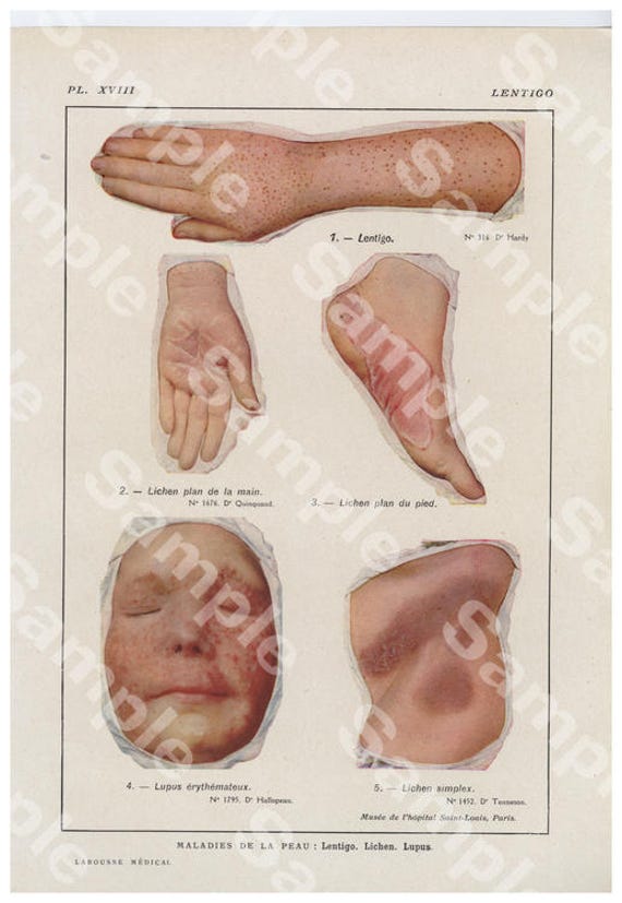 Gorgeous Original Antique Lithograph Color Print,Human anatomy Lentigo, Decorative art, Human organs,dates 1924