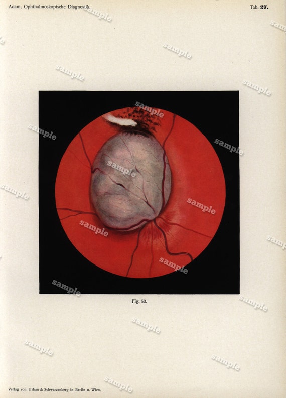 Antique Colored Original Human anatomy Print --Human Eyes -   -German Medical Encyclopedia 1902 -ophthalmology