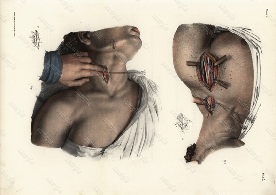 Original Antique colored Lithograph Human anatomy Gorgeous Engraving 1860-1870 -  Large Folio - medical operations Extracting Muscles