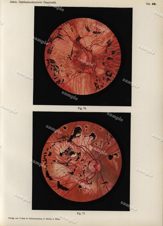 Antique Colored Original Human anatomy Print --Human Eyes -   -German Medical Encyclopedia 1902 -ophthalmology