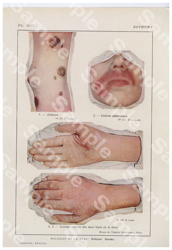 Gorgeous Original Antique Lithograph Color Print,Human anatomy hands infections,Rash,Decorative art, Human organs,dates 1924