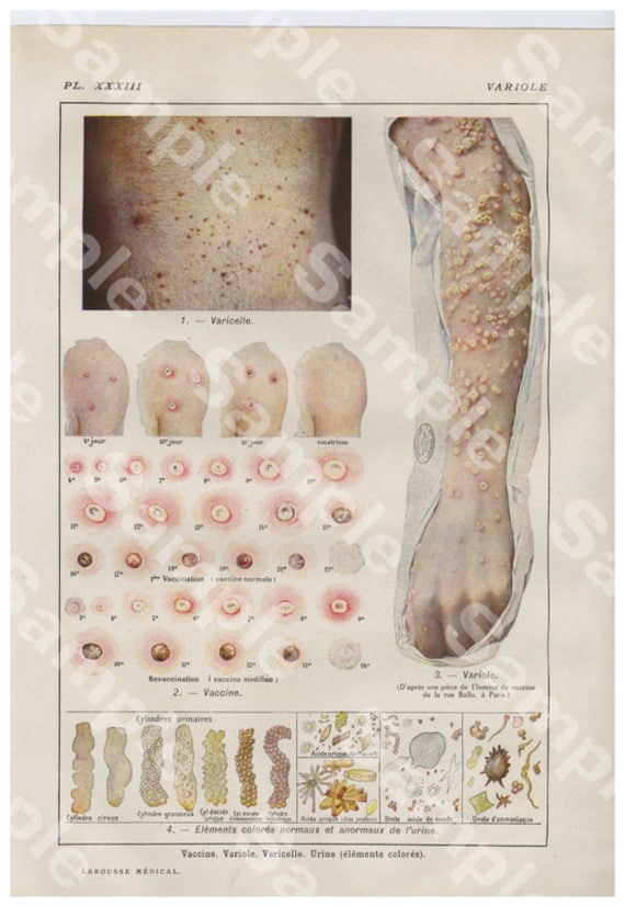 Gorgeous Original Antique Lithograph Color Print,Human anatomy infections, disease,organs,Rash, Decorative art, Human organs,dates 1924