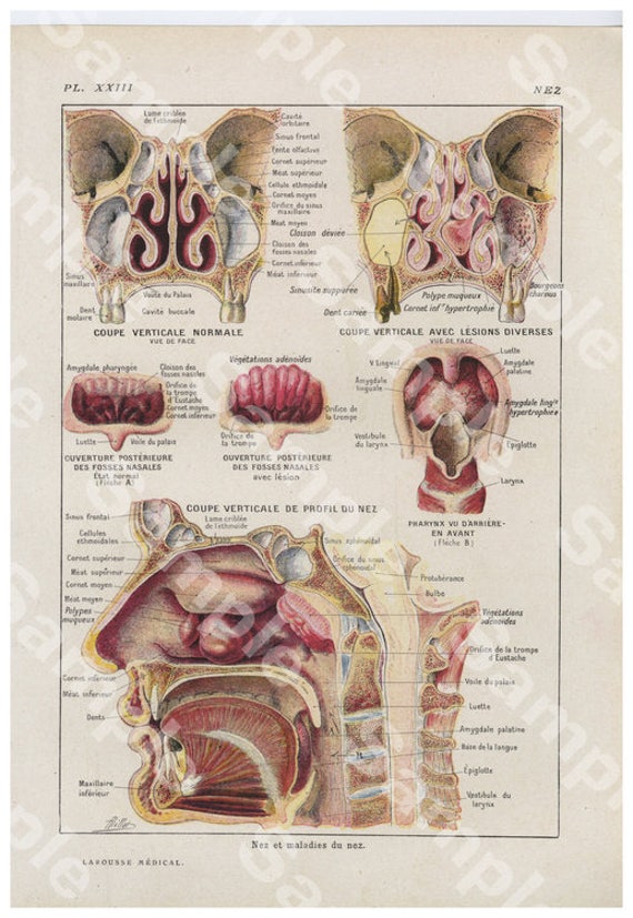 Gorgeous Original Antique Lithograph Color Print,Human anatomy infections, diseases, Decorative art, Human organs,dates 1924