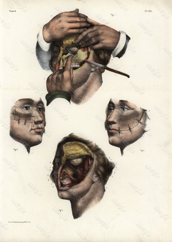 Original Antique colored Lithograph Human anatomy Gorgeous Engraving 1860-1870 -  Large Folio - Medical - Human Muscles - Operations