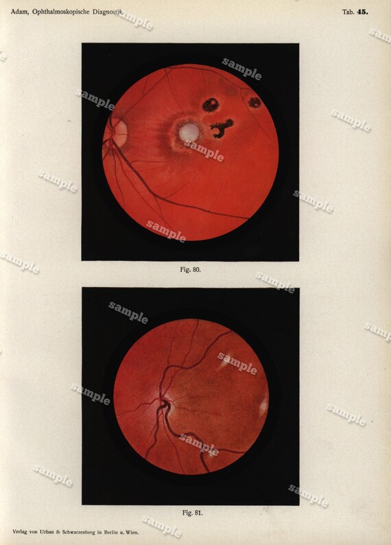 Antique Colored Original Human anatomy Print --Human Eyes -   -German Medical Encyclopedia 1902 -ophthalmology