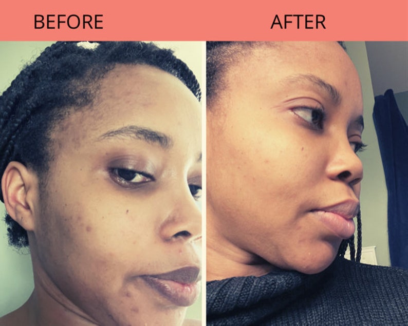 Kojic Acid Face Cream Moisturizer Under Eye Collagen Renew Etsy