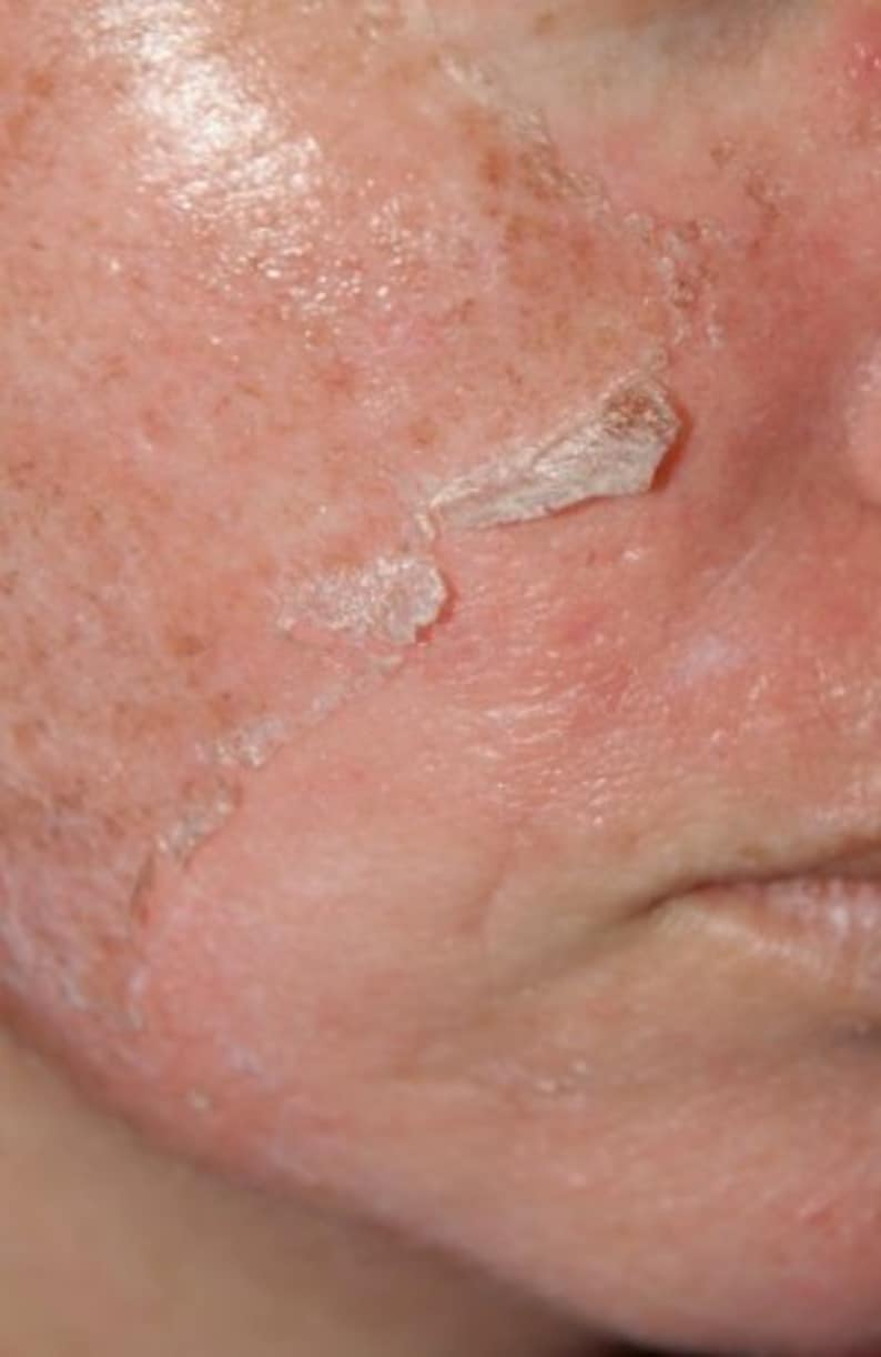 PeelPros TCA Acid Trio Kit 50 25 & 12 Chemical Peel Etsy