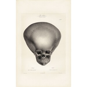 Joseph Vimont : Skull of a Hydrocephalus Child (Traite de Phrenologie, 1832) - Giclee Fine Art Print
