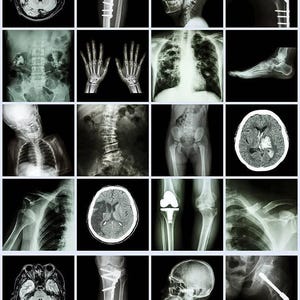 Peut inclure: Une collection d'images médicales, comprenant des radiographies et des IRM. Les images représentent des structures squelettiques, des organes internes et d'éventuelles affections médicales. Les scans montrent les os, les articulations et le cerveau.