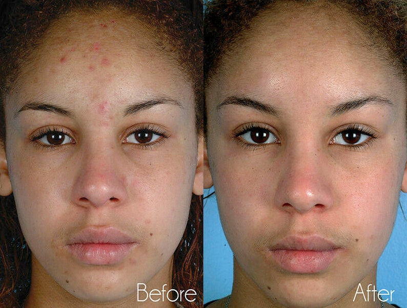 Microdermabrasion Cloth for Serious Exfoliation Using Just Etsy