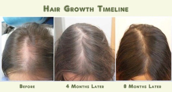 Best Hair Loss Conditioner Fast Re Growth 16 Organic Oils Etsy