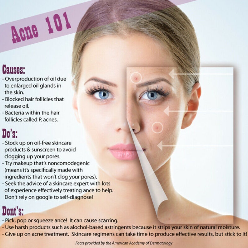 LACTIC ACID PEEL Kit Serum For Skin Discoloration Acne Etsy