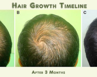 Best Hair Loss and Re-growth Serum Oil Treatment 16 Organic | Etsy