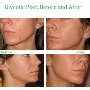 GLYCOLZUUR Chemische Peel Kit Revitaliseer uw huid Natuurlijke exfoliërende behandeling Een alfahydroxyzuur afbeelding 2