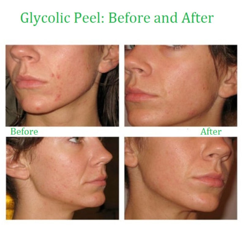 GLYCOLZUUR Chemische Peel Kit Revitaliseer uw huid Natuurlijke exfoliërende behandeling Een alfahydroxyzuur afbeelding 2