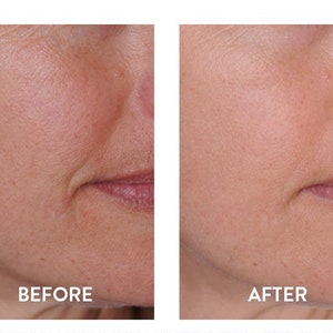 HYALURONIC ACID 100% Pure The 1 Wrinkle/Fine Line Filler used by Dermatologists image 3