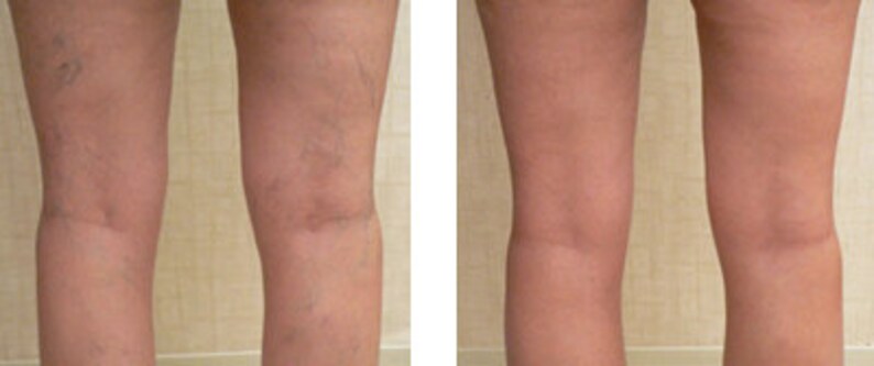 is vitamin k good for spider veins is vitamin k good for spider veins