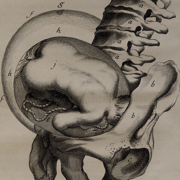 Important Observations about the ACCOUCHEMENT 1739 Antique print.Steel engraving.275 year old print.Medical print.7.8x9.8",25x20cm.        .