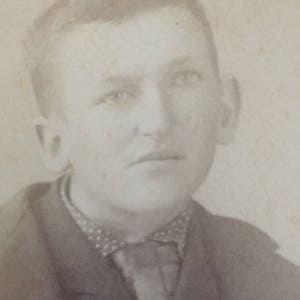 Antyczne wiktoriańskie zdjęcie chłopca ze skolizą i mikrosomią hemifacialną - Zainteresowanie medyczne - Carte de Visite