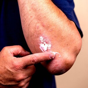 Person applying vegan body and hand cream to dry elbow hydrating moisturiser for rough dry skin cruelty free skincare