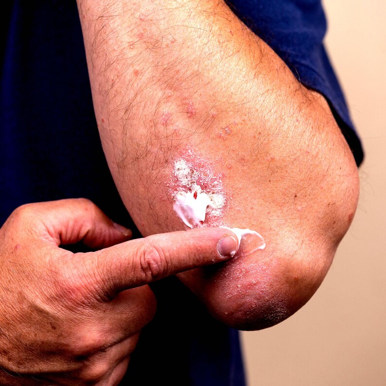 Person applying vegan body and hand cream to dry elbow hydrating moisturiser for rough dry skin cruelty free skincare