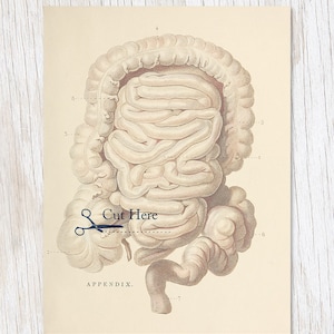 Anhang Schnitt Here Karte | Human Anatomy Geschenk, Biologie Geschenke, College Student Geschenk, Anhang Druck, Get Well Soon