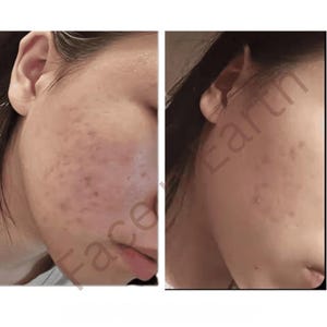 May include: A split image shows a side view of a person's face. The left side shows skin with acne and blemishes. The right side shows the same face with improved skin. The text "Face Earth" is partially visible.