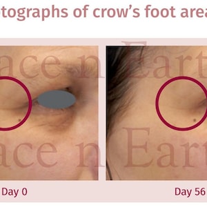 Puede incluir: Fotograf&iacute;as macro, lado a lado, del &aacute;rea de las patas de gallo alrededor del ojo. La imagen muestra el &aacute;rea antes y despu&eacute;s del tratamiento. El texto en la parte superior dice "Macro photographs of crow's foot area". El texto en la parte inferior dice "Day 0" y "Day 56".