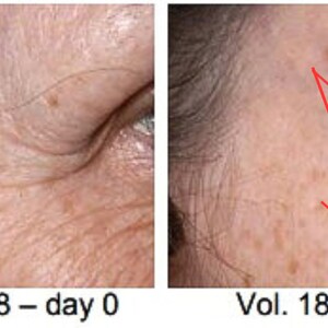 May include: Close-up before and after photos of a person's eye area showing the effects of a treatment. The before photo shows wrinkles around the eye. The after photo shows smoother skin with the wrinkles reduced. The text on the photos reads "Vol. 18 - day 0" and "Vol. 18 - day 84".