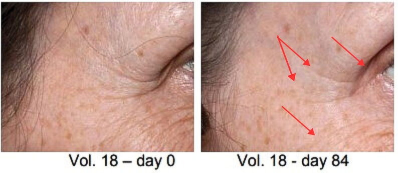 May include: Close-up before and after photos of a person's eye area showing the effects of a treatment. The before photo shows wrinkles around the eye. The after photo shows smoother skin with the wrinkles reduced. The text on the photos reads "Vol. 18 - day 0" and "Vol. 18 - day 84".