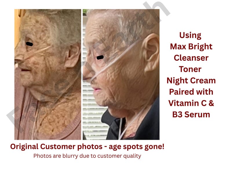 May include: Two side-by-side photographs showing a person's profile before and after using Max Bright Cleanser, Toner, Night Cream, Vitamin C, and B3 Serum. The text reads: Using Max Bright Cleanser Toner Night Cream Paired with Vitamin C & B3 Serum.