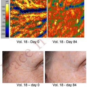 Puede incluir: Im&aacute;genes comparativas que muestran un an&aacute;lisis de la superficie de la piel y primeros planos de la piel facial. La secci&oacute;n superior muestra mapas de superficie codificados por colores, mientras que la secci&oacute;n inferior muestra la piel facial, etiquetada como "Vol. 18 - d&iacute;a 0" y "Vol. 18 - d&iacute;a 84".