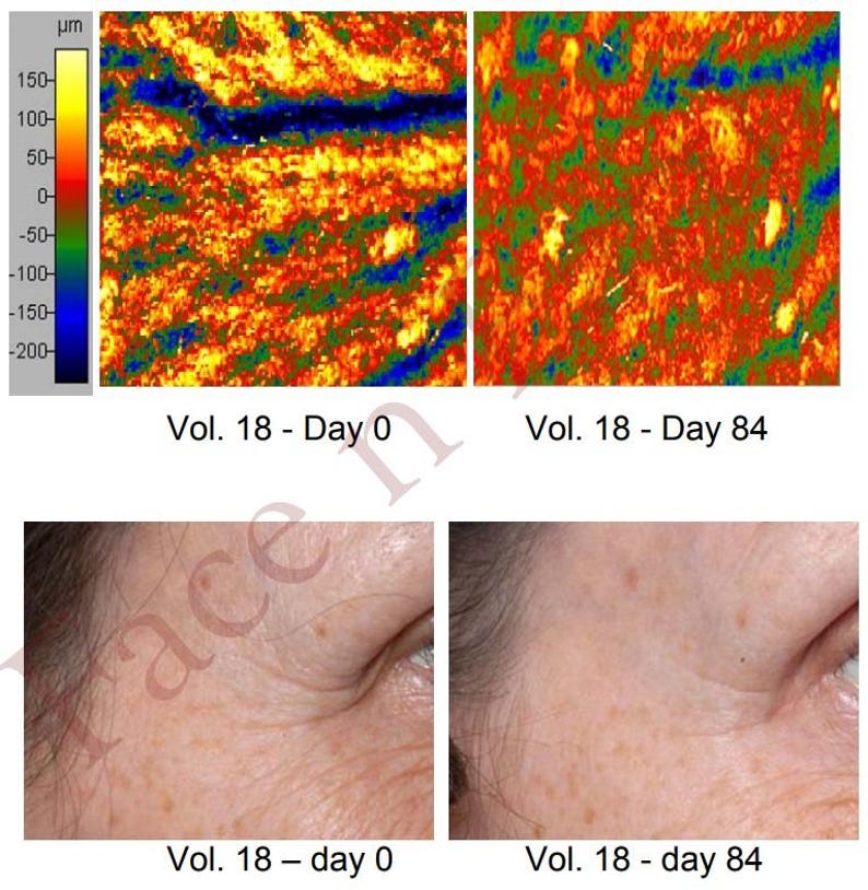 Puede incluir: Im&aacute;genes comparativas que muestran un an&aacute;lisis de la superficie de la piel y primeros planos de la piel facial. La secci&oacute;n superior muestra mapas de superficie codificados por colores, mientras que la secci&oacute;n inferior muestra la piel facial, etiquetada como "Vol. 18 - d&iacute;a 0" y "Vol. 18 - d&iacute;a 84".