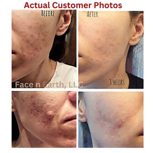 May include: A composite image showing two sets of before and after facial skin comparisons labeled Actual Customer Photos, Before, After, 3 weeks, and Face n Earth, LLC. The images display skin texture changes on the cheek and jawline areas.
