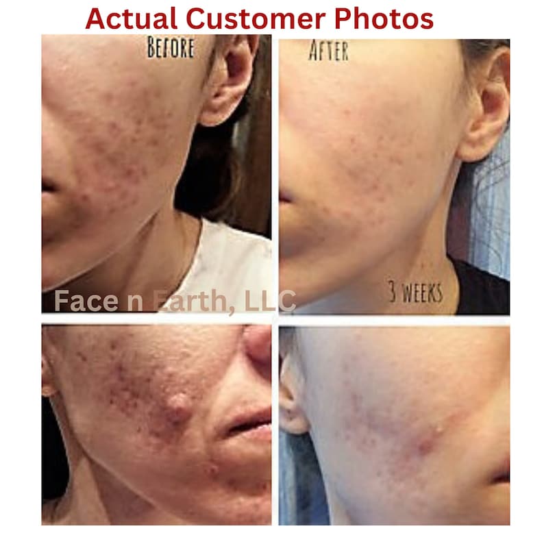 May include: A composite image showing two sets of before and after facial skin comparisons labeled Actual Customer Photos, Before, After, 3 weeks, and Face n Earth, LLC. The images display skin texture changes on the cheek and jawline areas.