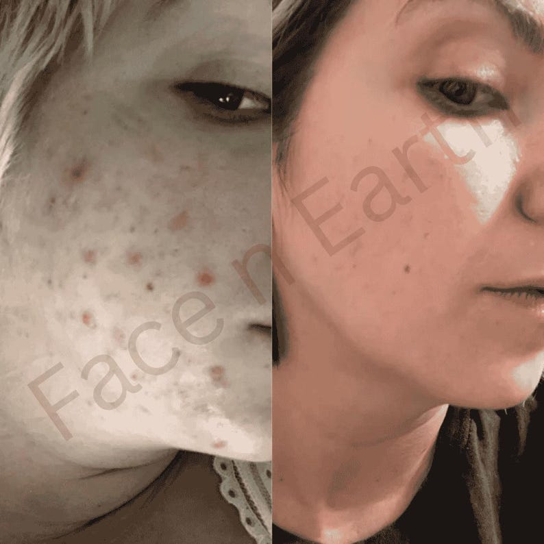 May include: A split-screen comparison showing a side profile of a face with visible red acne spots on the left and a clearer complexion on the right. The text Face n Earth is overlaid diagonally across the center of the image in a light font.