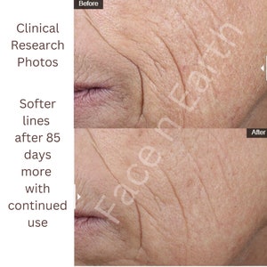 May include: A split-screen comparison of skin texture labeled Before and After. The top image shows deeper facial wrinkles, while the bottom image shows reduced lines. Text reads: Clinical Research Photos, Softer lines after 85 days more with continued use, Face n Earth.