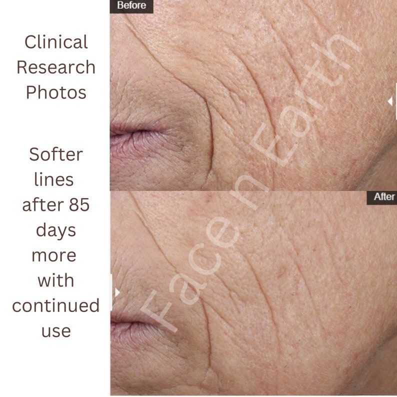 May include: A split-screen comparison of skin texture labeled Before and After. The top image shows deeper facial wrinkles, while the bottom image shows reduced lines. Text reads: Clinical Research Photos, Softer lines after 85 days more with continued use, Face n Earth.