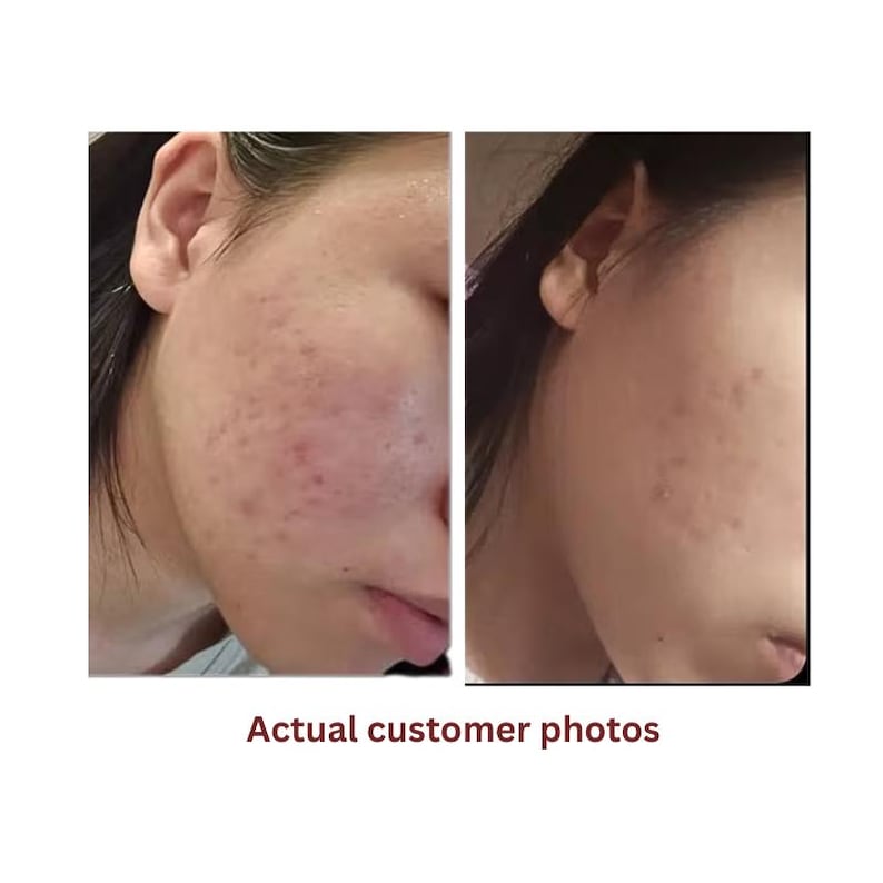 May include: A side-by-side comparison of two photographs showing the same facial skin area. The left image displays visible acne and skin texture, while the right image shows the same skin area with a reduction in visible acne and redness.