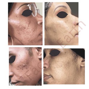 May include: A composite of four close-up views showing facial skin texture. The images display variations in skin tone, visible pores, and surface irregularities on the cheek and jawline areas. The text "Face Earth" is partially visible in light red.
