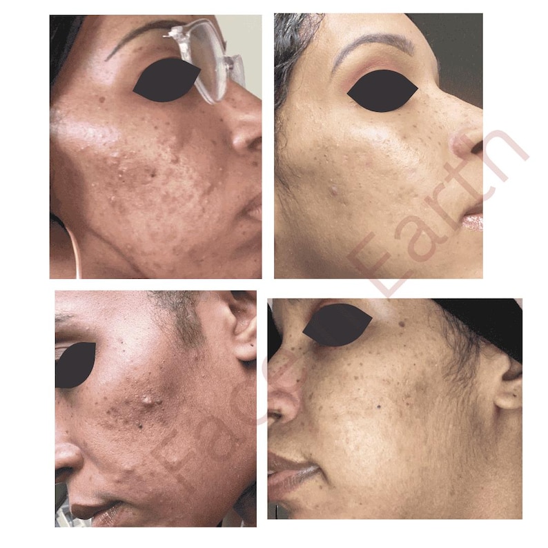 May include: A composite of four close-up views showing facial skin texture. The images display variations in skin tone, visible pores, and surface irregularities on the cheek and jawline areas. The text "Face Earth" is partially visible in light red.
