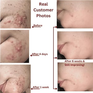 Deep Pore Face Wash | Purifying White Willow Bark Cleanser for Oil-Prone Skin image 7