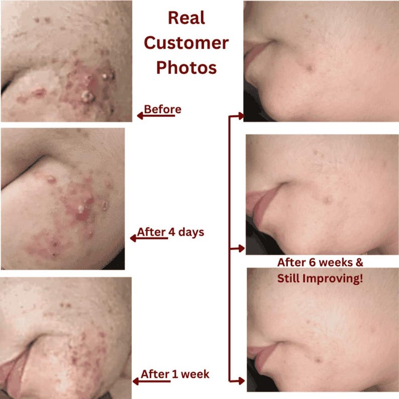 Deep Pore Face Wash | Purifying White Willow Bark Cleanser for Oil-Prone Skin image 7