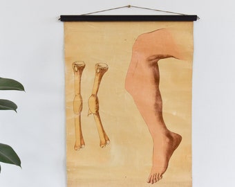 Vintage Small Ruddiman Johnston & Co Ltd, London Early 20th Century Anatomical Poster of a Broken Leg