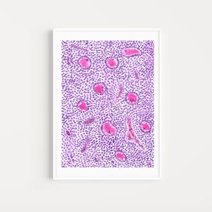 Granulosa Cell Tumor Watercolor Histology Art Print: Medical Pathology Decor (Digital Download