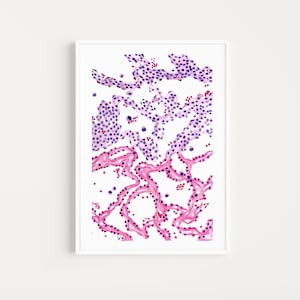 Interstitial pneumonia digital download, lung art , histology art, pulmonologist gift, doctor gift, pathology art, watercolor histology