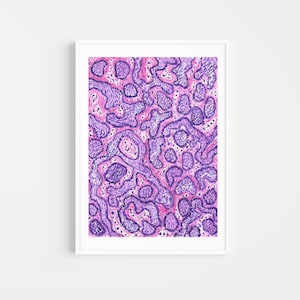 Ameloblastoma Histology Watercolor Print, Rare Pathology Digital Poster, Oral Pathology Wall Art, Doctor Office Decor, Medical Student Gift